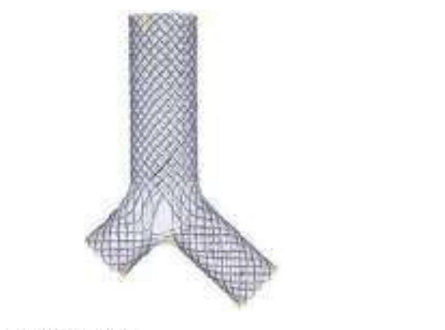 Stent Traheal/Bronșic în Formă de Y